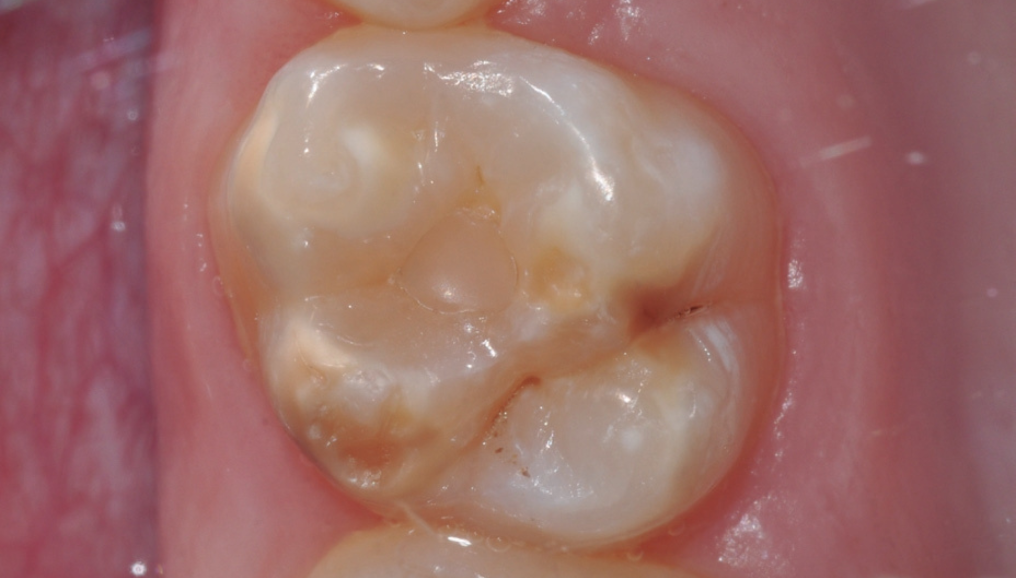 Tratar la Hipomineralización incisivo-molar (MIH) es crucial para mejorar la salud bucodental